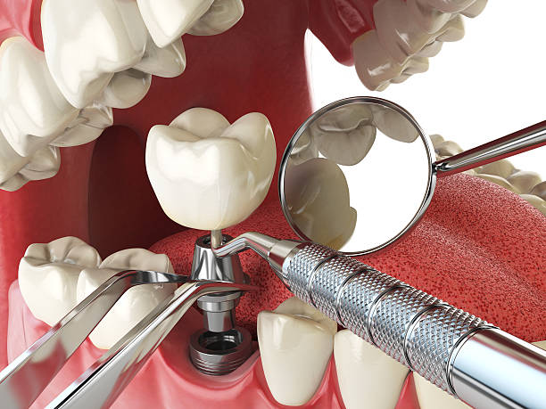 Best Emergency Dentist for Lost Fillings or Crowns in Bermuda Dunes, CA
